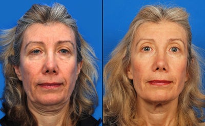 Ultherapy - Ultherapy