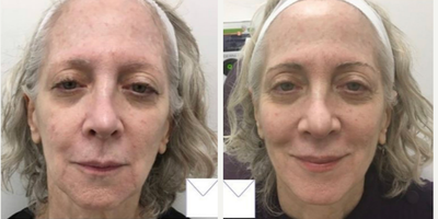 Woman treated with RHA Collection Fillers, Skin Rejuvenation - Injectables and Fillers