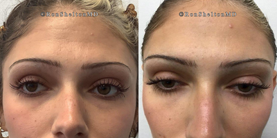 35-44 year old woman treated with Jeuveau - Fine lines forehead treated with Jeuveau