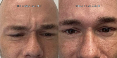 35-44 year old man treated with Jeuveau - 4 Days After Jeuveau on Glabella Frown Lines and Crows Feet