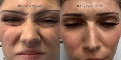 35-44 year old woman treated with Jeuveau - Fine lines forehead and glabellar frown treated with Jeuveau