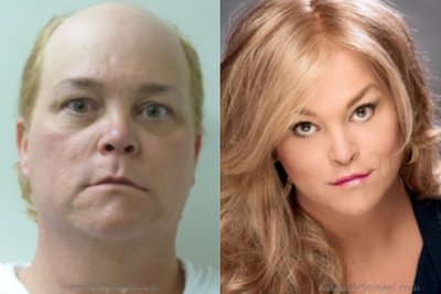 45-54 year old woman treated with Facial Feminization Surgery - Facial Feminization Surgery