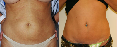 Mini-abdominoplasty - 
	before and three months after standard mini-tummy tuck

