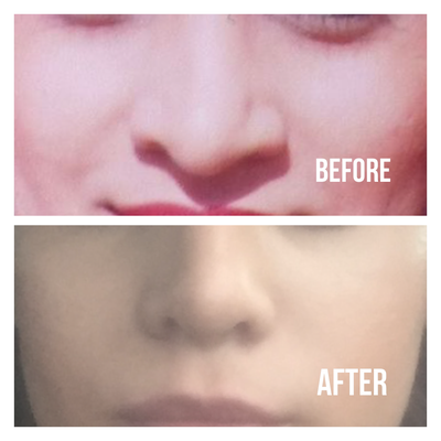 Rhinoplasty Hakan Gence Md Review Realself