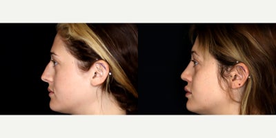 29 year old woman treated with Rhinoplasty, Voluma, Juvederm - 29 year old woman treated with rhinoplasty, 1 syringe of Voluma to cheeks, 1.5 syringe of Juvederm Ultra CX to lips and 0.5 syringe of Juvederm Ultra XC to nasalabial folds. Photos depict before and 3 months after treatment.