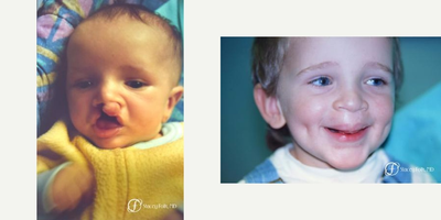 17 or under year old man treated with Cleft Lip And Palate Repair - Cleft lip and palate repair