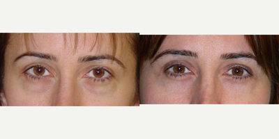 45-54 year old woman treated with Eyelid Surgery - lower blepharoplasty