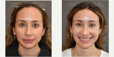 25-34 year old woman treated with Forehead Reduction - This patient felt her forehead was too high and wanted to lower her hairline. She underwent a one-stage forehead reduction/hairline lowering procedure. Here she is before and one-month after the procedure.