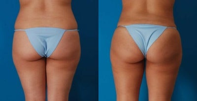 25-34 year old woman treated with Butt Augmentation - Procedure: Liposuction of abdomen, flanks, arms, and axillae, and buttock fat injection, and touch up 4.5 months later.Before, 2.5 months after her second fat injection procedure.