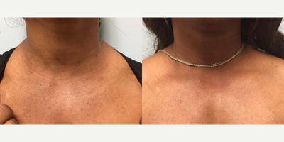 Skin tag removal with Aerolase - Bothered by the appearance of her neck and decollete, Aerolase laser treatment was performed in my office to remove her skin tags without any side effects such as skin discoloration or the need for multiple treatments.