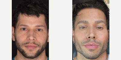 Man treated with Facial - Man treated with Facial