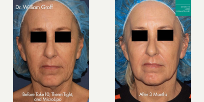 45-54 year old woman treated with Laser Resurfacing, ThermiTight, Liposculpture - Take10, ThermiTight, and MicroLipo for skin rejuvenation