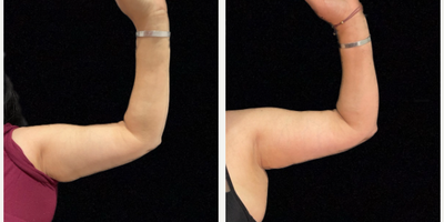 Woman treated with SculpSure - Woman treated with SculpSure