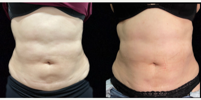 Woman treated with SculpSure - Woman treated with SculpSure
