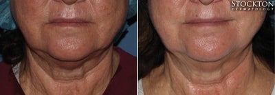 65-74 year old woman treated with Inmode Fractora Forma - Fractora Forma is for individuals who are looking for a non-invasive and natural looking approach to improve skin tone, laxity, and irregular texture. Patients who have tried Fractora Forma report smoother skin, with visible lift, improved definition, and decrease in wrinkles. Fractora Forma is safe for all skin types and can even be performed on tanned skin.How RF Skin Tightening Works- Fractora Forma can treat sagging skin on the entire face or the lack of definition in certain areas like the crows feet, upper eye lids, naso-labial folds (laugh lines), jowls, and neck. Treatment of the body may include arms (bat wings), abdomen, thighs, knees, and other areas that can benefit from tissue contraction. For best results, it is recommended that weekly sessions are performed in a six week period.. For pronounced laxity, your provider may recommend 8 treatments over an 8 week period. The best candidates for this procedure are at their optimal weight. Any weight changes post treatment (weight loss or weight gain) can alter results.