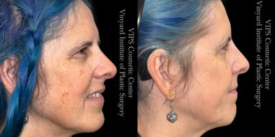 55-64 year old woman treated with Skin Lightening, Skin Rejuvenation, IPL - This patient was looking to enhance her skins radiance and address concerns like uneven tone, fine lines, and dullness. With just one session of the Elluminate Advanced Photofacial, she achieved a brighter, smoother, and more even complexion. This cutting-edge treatment worked to rejuvenate multiple layers of her skin, targeting redness, hyperpigmentation, and texture irregularities. The result? A naturally refreshed and youthful glow that has left her feeling confident and revitalizedall with little to no downtime.