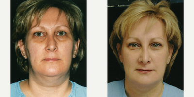 45-54 year old woman treated with Liposculpture - liposuction neck in office under sedation