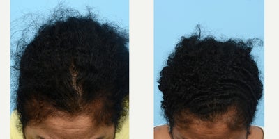 45-54 year old woman treated with Hair Loss Treatment - In order to combat thinning and wake up dormant hair follicles, this patient underwent a series of three Platelet Rich Plasma treatments, each spaced about a month apart for optimal results. Dr. Wise also recommended Nutrafol supplements for overall hair health. 7 months post-treatment, the patient is very happy with the new growth on the sides of her hairline, as well as the overall thickness of her hair. More growth is expected by the one year mark.