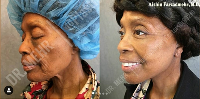 Woman treated with Facelift - Woman treated with Facelift