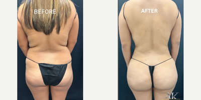 Woman treated with Laser Liposuction - Its all about confidence. Sometimes just a few little changes can make a world of difference to how you feel about yourself. Our patient received lipo360+ with a fat transfer. Now she is enjoying an hour glass figure. .
