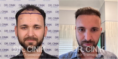 35-44 year old man treated with FUE Hair Transplant - 38 Years Old Male Patient - Norwood IV  - 4325 Grafts
