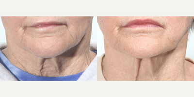 Woman treated with Pixel Laser - These are Before and Afters of a patients neck following 3 treatments with our Pixel8-RF (microneedling with radiofrequency)....(and a small amount of permanent lip filler, Silikon 1000)