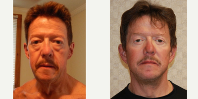 55-64 year old man treated with Fat Transfer, Upper and Lower Eyelids, Face and Neck Lift - My patient had undergone a 160lb weight loss after bariatric surgery. He had heavy eyelids, bags under the eyes, neck banding and jowling, with severe volume loss in his face. His under eye area was exacerbated by both the under eye fat bags as well as the volume loss in his cheeks. He underwent a Face and Necklift, Upper and Lower Blepharoplasty, and&nbsp;a Fat Transfer to return his youthful cheek contours, soften the under eye hollows and the nasolabial and marionette lines. The Upper and Lower eyelid surgery awakens his eyes and the face and neck lift improves his facial contours.