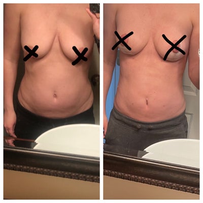 Breast Lift NO Implants +liposuction - Review - RealSelf