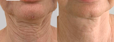 55-64 year old woman treated with Fractora RF - Patient with sagging neck, in it we have implemented a fractional radiofrequency technology, in the photo you have two sessions of this procedure with an interval of 6 weeks between one session and another. does not generate inclapacity, must be assessed by a doctor, the ideal is to combine it with other technologies to optimize results.