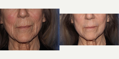 65-74 year old woman treated with Scar Removal, Laser Scar Removal - Laser resurfacing of mouth