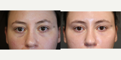 Regenerative Therapies for Under Eyes - Filler, PRP, laser utilized subtly over time to improve lower lids.