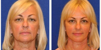Woman treated with Neck Lift - Neck Lift