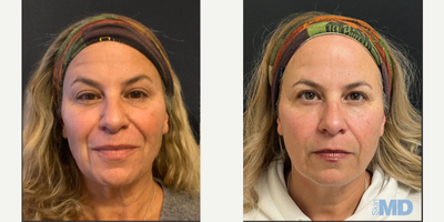45-54 year old woman treated with NeoGen Plasma - This patient received IPL NeoGen Tx. Results will continue to improve over 60 and 90 days.