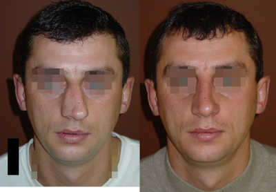 Crooked nose correction - 
	Typical post trauma nose crooked nose corection
