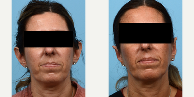 35-44 year old woman treated with Ear Surgery - This 41-year-old patient wanted to reduce the prominence of her ears. Dr. Wise performed an otoplasty, also known as ear-pinning surgery, to reduce the protrusion. 2 months post-op she feels more confident and loves her results!