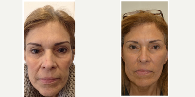 55-64 year old woman treated with Thread Lift - This lady had 2 mls of Radiesse in the cheeks, nasolabial folds and jawline followed by PDO threads in the mandibular area to lift the jowls and strengthen the jawline.