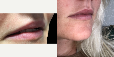 25-34 year old woman treated with Lip Fillers - Lip Filler