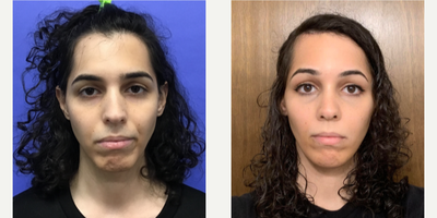 Transgender woman treated with Transgender Facial Feminization Surgery - Transgender woman treated with Facial Feminization Surgery, shown 1 month post op.
