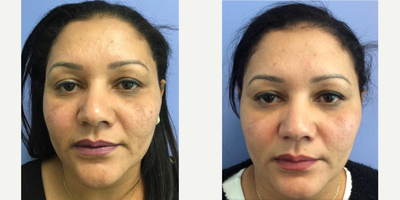 Clear & Brilliant - Results after 1 Clear & Brilliant Treatment for melasma