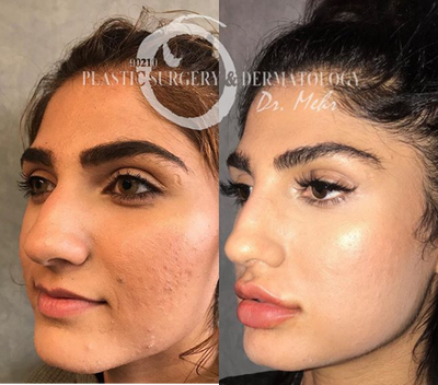 Woman treated with Restylane - Woman treated with Restylane