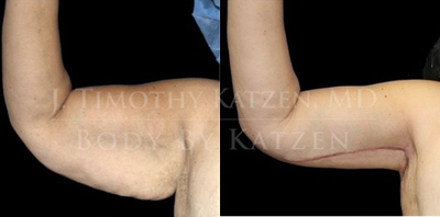 Woman treated with Arm Lift - Woman treated with Arm Lift