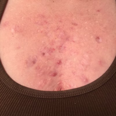Is there any way to get rid of my scars on my chest and Is there any way to get rid of my scars on my chest and