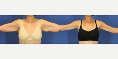 55-64 year old woman treated with Arm Lift - Brachioplasty - 120lb weight loss. 56yo. 6 months post