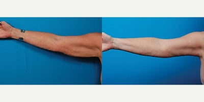 55-64 year old woman treated with Arm Lift - Procedure: Brachioplasties, liposuction of arms and axillae.