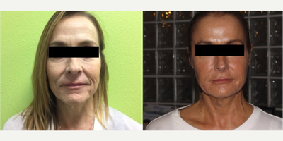 45-54 year old woman treated with Infini RF - Three Infini RF treatments at 4 week intervals. Dermal filler cheeks - Voluma, lower face and lips - Juvaderm Ultra.