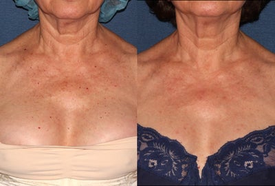 56 year old female with sun damage and red and brown spots on chest - 
	56 year old female concerned with mottled brown discoloration, red and brown spots, and sun damage to chest. I performed one treatment on her chest with the M22 IPL and the Vbeam Perfecta laser, both on the same day.
