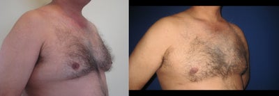 Laser Liposuction - Gynecomastia - Laser Liposuction - Gynecomastia