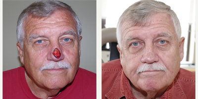 55-64 year old man treated with Facial Reconstructive Surgery - 64 year old male received MOHS Repair; photos depict the patient's results 6 months post-op.
