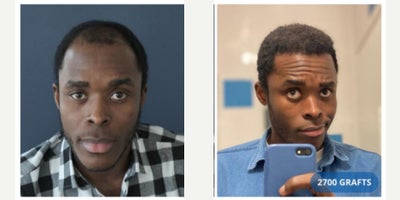 25-34 year old man treated with FUE Hair Transplant - This 2534-year-old male patient with Afro-textured hair came to our clinic with progressive frontal thinning and a receding hairline that had started to affect his appearance and confidence. After a detailed evaluation, he was determined to be an excellent candidate for an Afro FUE hair transplant.The procedure was performed using the Follicular Unit Extraction (FUE) method, which requires specific expertise when working with curly and Afro-textured hair due to the natural curvature of the follicles. A total of 2,700 grafts were carefully harvested from the occipital donor area and implanted into the frontal and parietal zones, restoring density and creating a natural, age-appropriate hairline.During surgery, a session of PRP therapy was also performed to support graft survival, stimulate healing, and improve overall hair growth.For post-hair transplant care, the patient was advised to follow a dedicated routine. He was specifically recommended Folliactiv shampoo and spray with Saw Palmetto extract to strengthen transplanted hair, minimize shedding, and ensure long-term results.The surgery was carried out under local anesthesia with minimal discomfort, and the patient was able to return to his daily activities within just a few days. At follow-up, he achieved excellent density and a natural-looking Afro hairline that blended seamlessly with his facial features. The outcome significantly improved his overall appearance and boosted his confidence.