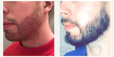 25-34 year old man treated with Beard Transplant - This 2534-year-old male patient came to our clinic with patchy and uneven facial hair growth, which affected his overall appearance and confidence. After a thorough consultation and donor area evaluation, he was considered a good candidate for a beard transplant using the DHI (Direct Hair Implantation) technique.The procedure was performed with the DHI method, which allows direct implantation of grafts with high precision and natural angulation. A total of 2,900 grafts were harvested from the occipital donor area and carefully implanted into the beard region, including the cheeks, jawline, and mustache area, to restore density and symmetry.To further improve graft survival and healing, one session of PRP therapy was performed during surgery.For post-transplant care, the patient was advised to follow a dedicated routine, including Folliactiv shampoo and spray with Saw Palmetto extract, to strengthen the transplanted hairs, minimize shedding, and ensure long-term results.The surgery was carried out under local anesthesia with minimal discomfort, and the patient was able to return to daily activities within a few days. At follow-up, he achieved excellent beard density, with a natural-looking facial hair pattern that enhanced his appearance and boosted his self-confidence.